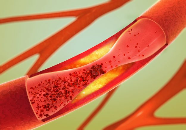 Ablagerung und Verengung einer Arterie – Arteriosklerose